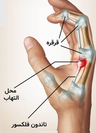 انگشت ماشه ای (تریگر فینگر) 